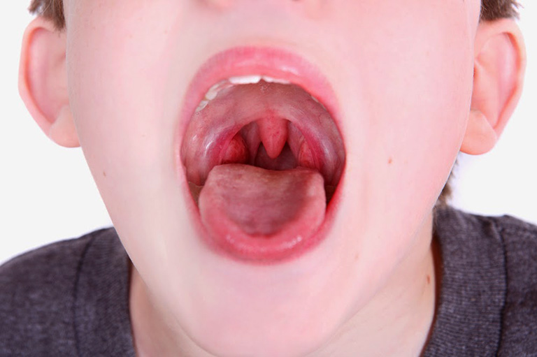 Viêm VA mãn tính - Hình ảnh minh họa